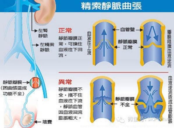 關于2021年征兵精索靜脈曲張標準的探討，2021年征兵精索靜脈曲張標準深度解析