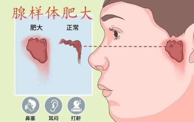 腺樣體肥大能自愈嗎？——深度解析與理解，腺樣體肥大能否自愈？全面深度解析