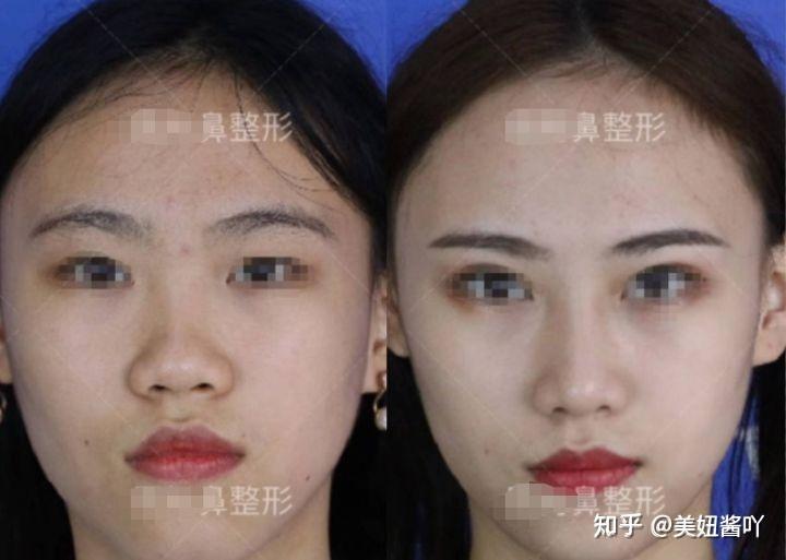 成都隆鼻專家前十名，專業(yè)技藝與信譽(yù)并重，成都隆鼻專家前十名，技藝與信譽(yù)并重的專業(yè)醫(yī)師