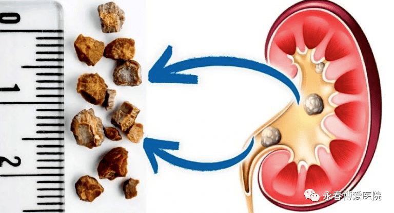 腎結(jié)石的最好治療方法有哪些，腎結(jié)石的最佳治療方法介紹