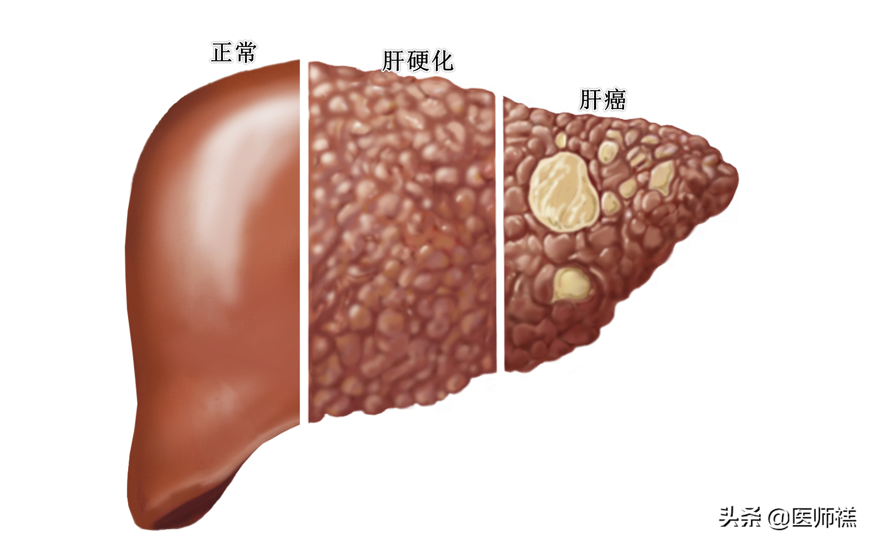 早期硬化的肝能治愈嗎，全面解析與希望，早期肝硬化能否治愈，全面解析與預(yù)后展望