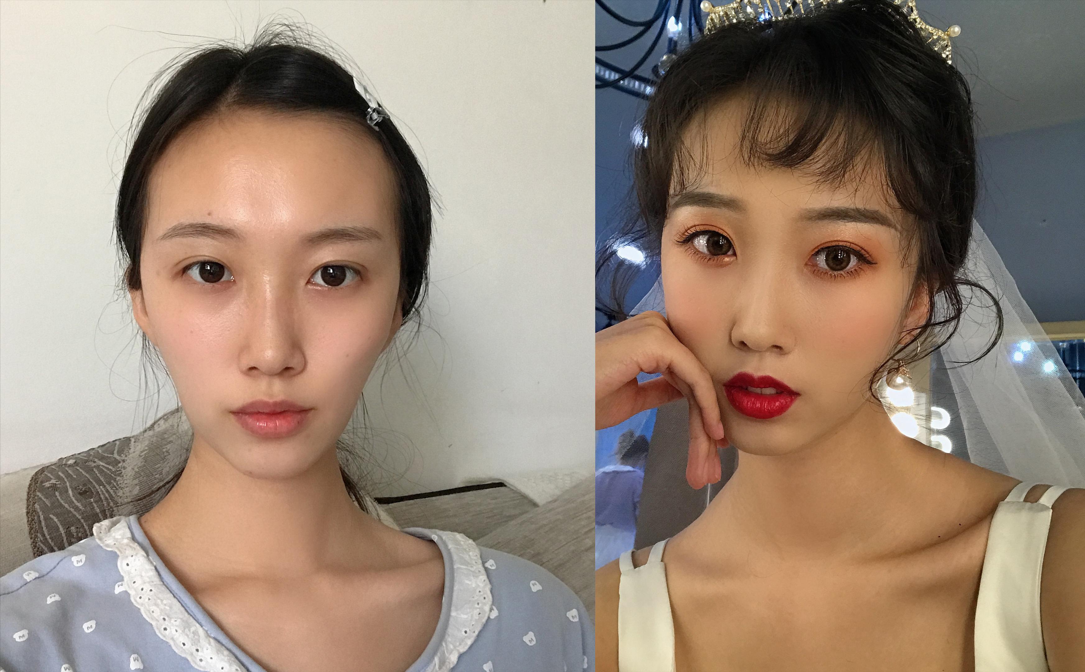 自體填充脂肪，利弊分析，自體脂肪填充的利弊分析