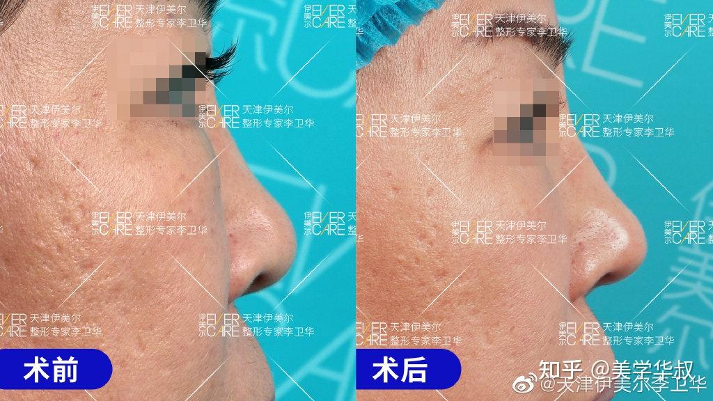 捏鼻三年，鼻頭變大——深度解析捏鼻子對鼻子的影響及應(yīng)對之策，捏鼻三年的影響，鼻頭變大原因解析與應(yīng)對之策