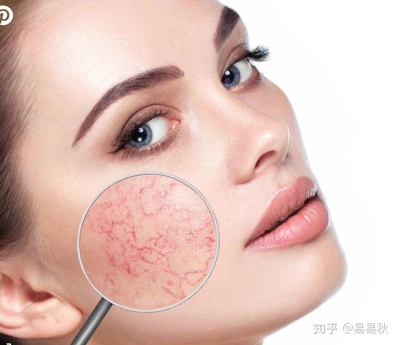 改善面部紅血絲的方法，改善面部紅血絲的有效方法