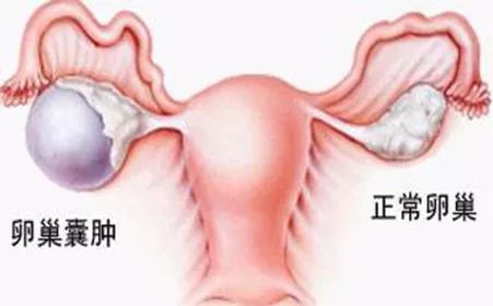 卵巢囊腫的十個(gè)征兆，卵巢囊腫的十個(gè)征兆解析
