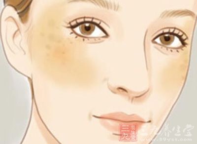怎樣祛除黃褐斑最有效的方法，最有效的黃褐斑祛除方法