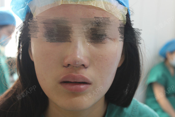 不動(dòng)手術(shù)縮小鼻頭，自然方法與實(shí)用技巧，自然縮小鼻頭的方法與實(shí)用技巧分享